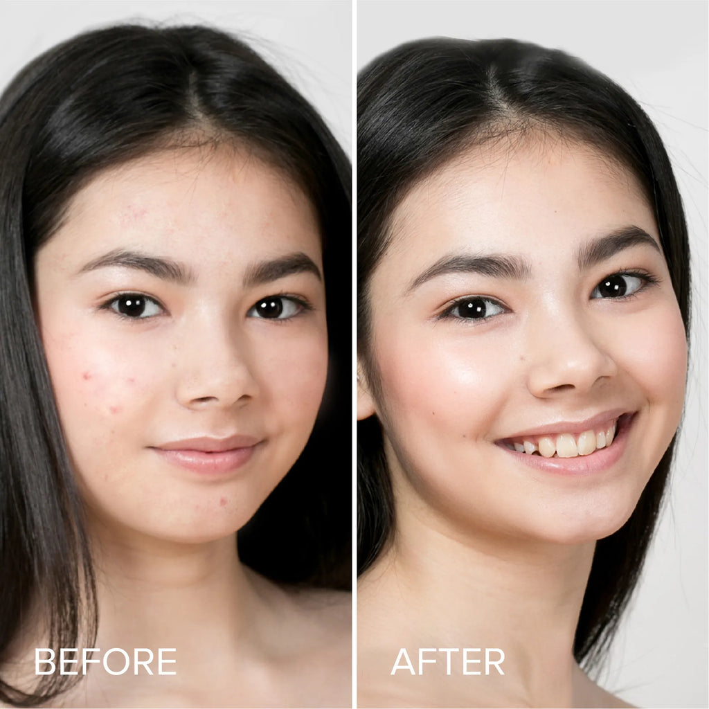 Pimple & Acne Patches